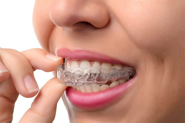 مقایسه ارتودنسی نامرئی و ارتودنسی ثابت